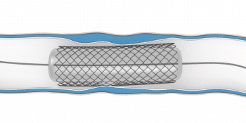 Stent-Therapie