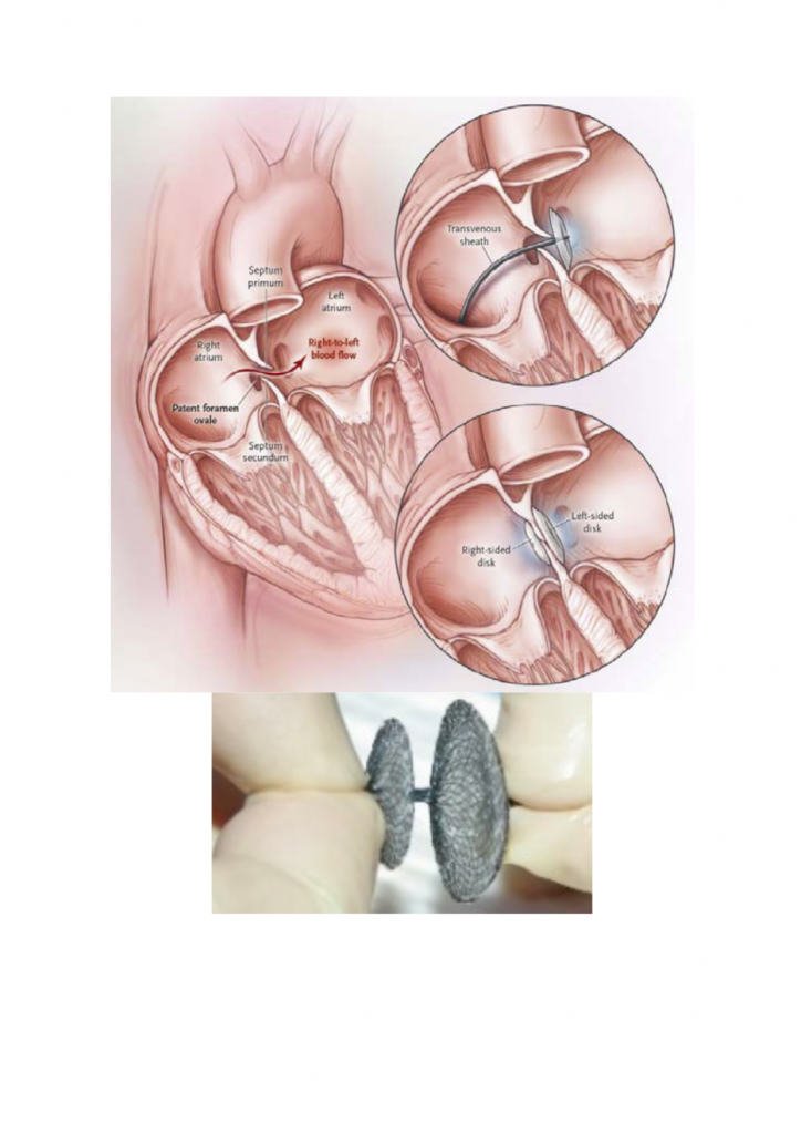 PFO/ASD Occluder